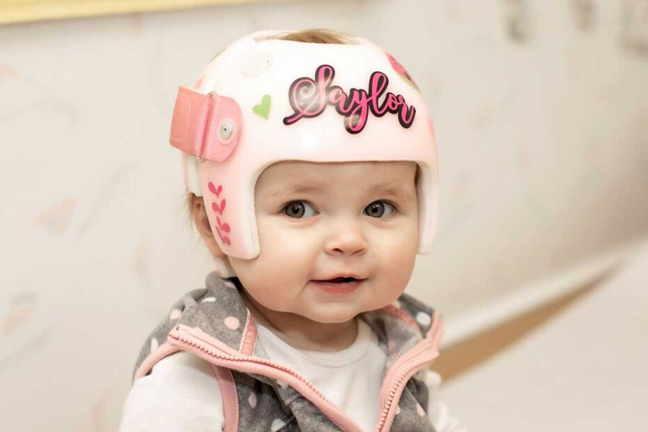 Child With Positional Plagiocephaly Being Treated With a Cranial Remodeling Orthosis