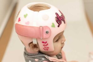 Positional Plagiocephaly is Treatable with a Cranial Remodeling Orthosis
