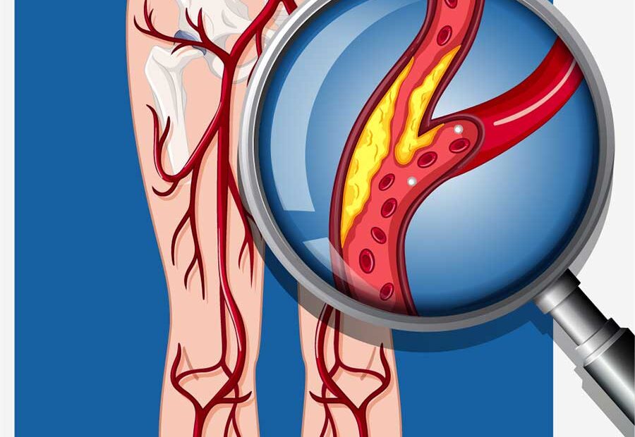 Peripherial Artery Disease (PAD)