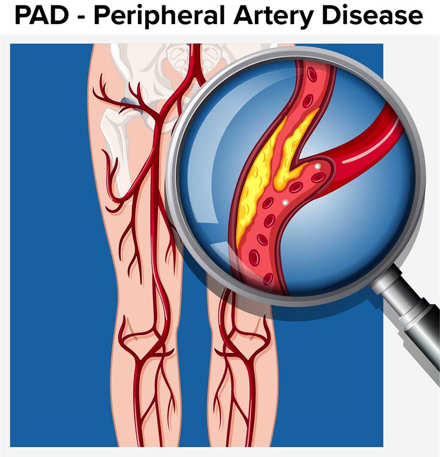 Peripherial Artery Disease (PAD)