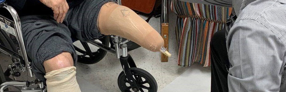 How a Custom Prosthetic Socket Is Made: Step by Step