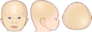 brachycephaly - Does My Child Need a Cranial Helmet? What Parents Should Know