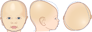 Brachy-Plagio - Does My Child Need a Cranial Helmet? What Parents Should Know