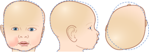 Plagiocephaly - Does My Child Need a Cranial Helmet? What Parents Should Know