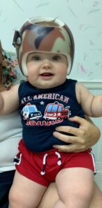Does My Child Need a Cranial Helmet? What Parents Should Know