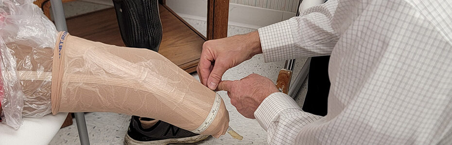 Why We Still Hand Cast Prosthetic Sockets (And Why It Matters)