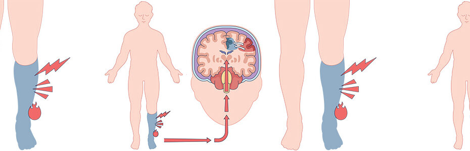 The Truth About Phantom Limb Pain and What Helps
