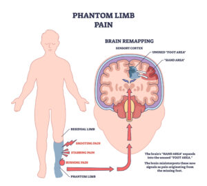 The Truth About Phantom Limb Pain and What Helps