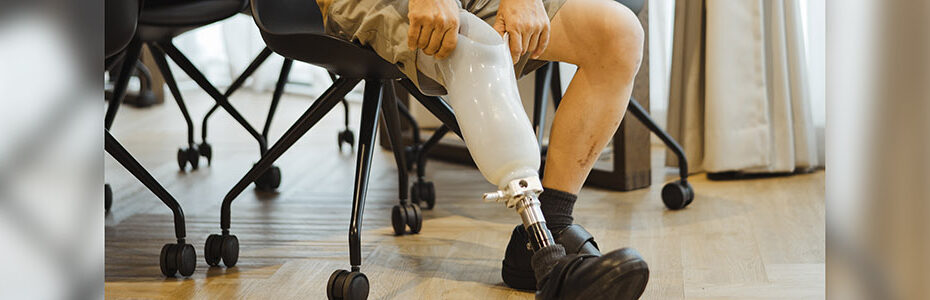 How to Know If Your Prosthetic Socket Fits Correctly