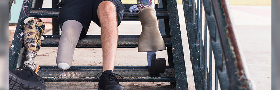 5 Signs You Need a New Prosthesis