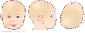 Torticollis and Flat Head Syndrome: Why They Often Show Up Together