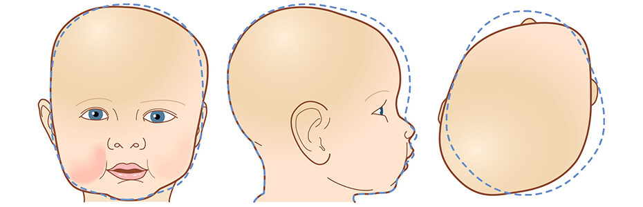 Torticollis and Flat Head Syndrome: Why They Often Show Up Together